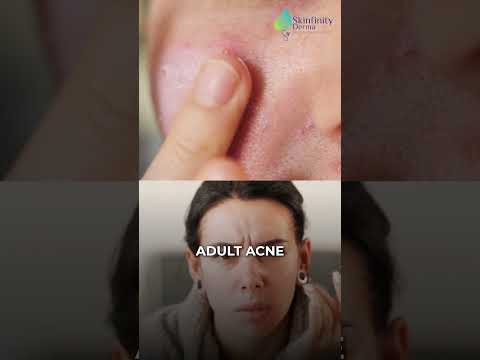 Effects of High Cortisol #skinfinityderma #dermatologyclinic