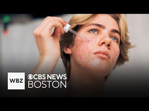 CBS Boston - "cortisol face may not actually be caused by..."
