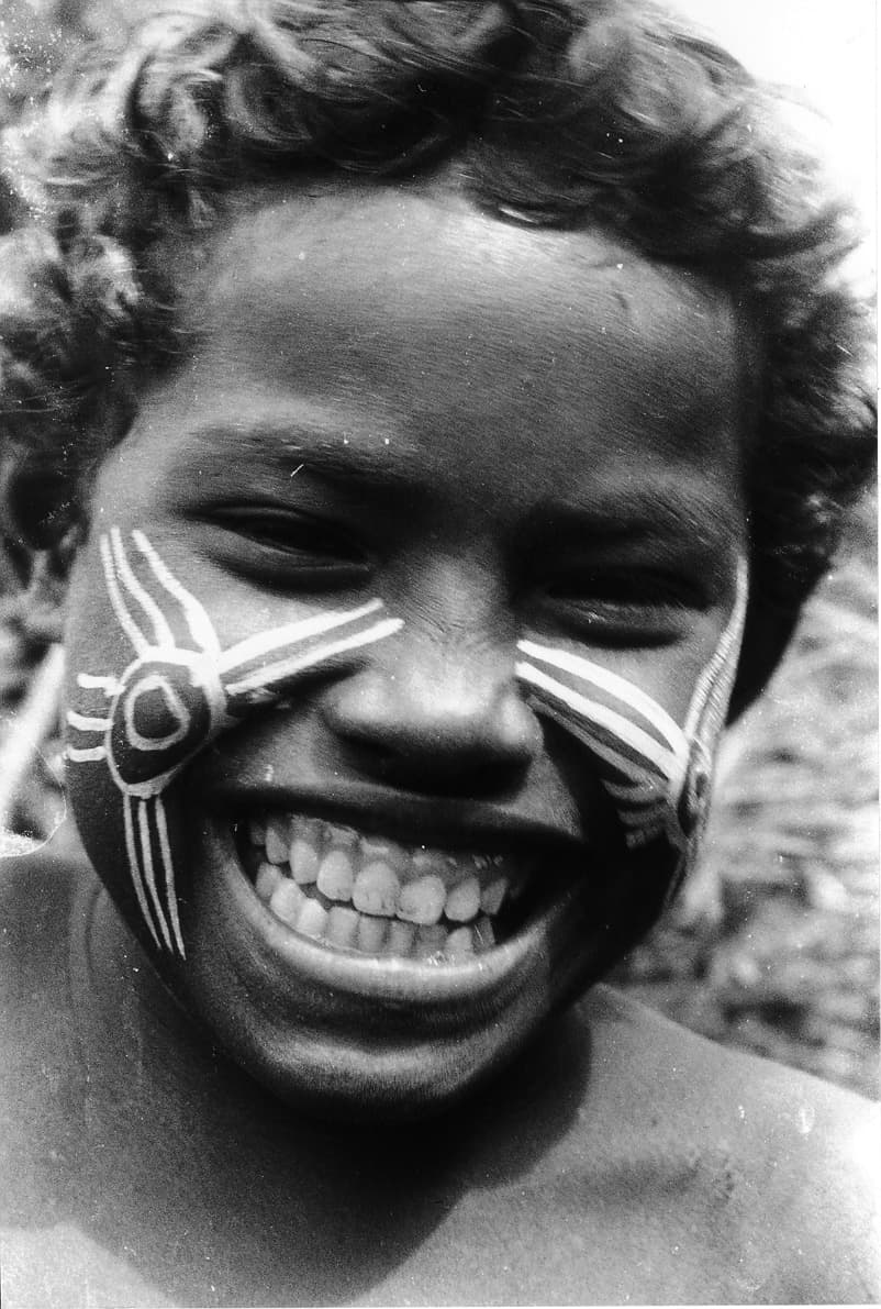 Freshly recut scarification on a child's face